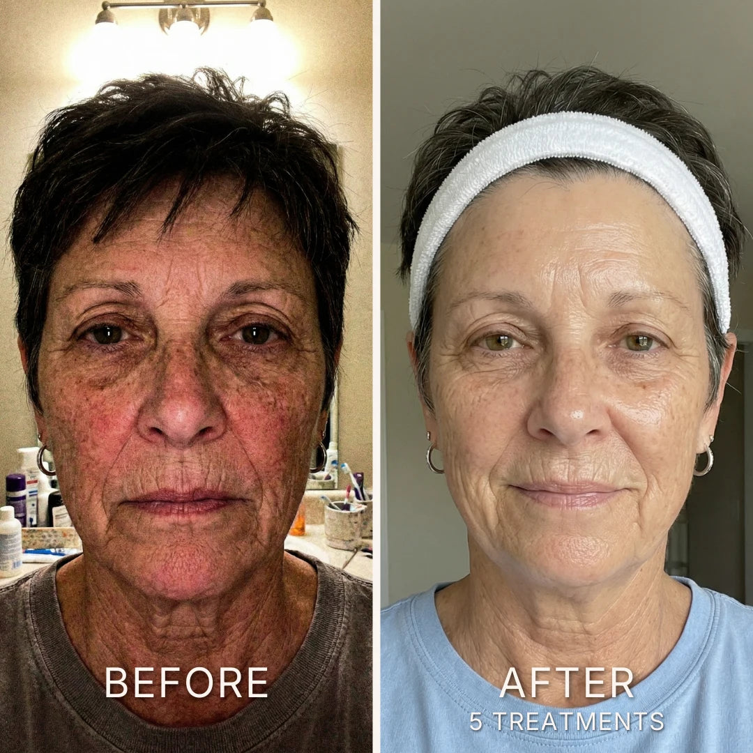 Caviar Micro-Infusion Facial System