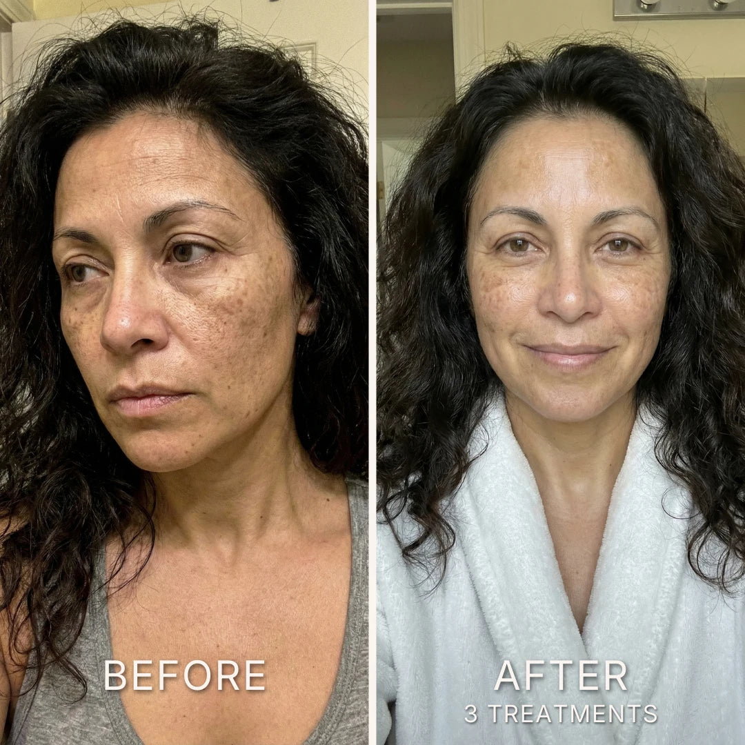 Before and after micro-infusion results